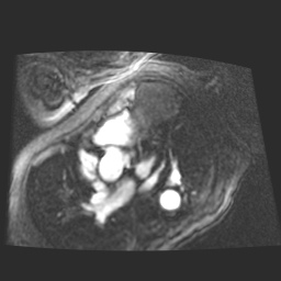 File:Cardiac fibroma (Radiopaedia 38974-41150 4 chamber FGRET 5).jpg