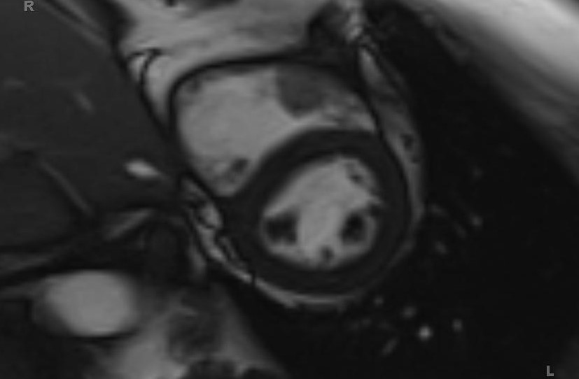 Cardiac hemangioma (Radiopaedia 31709-32631 Short axis Cine SSFP 20).jpg