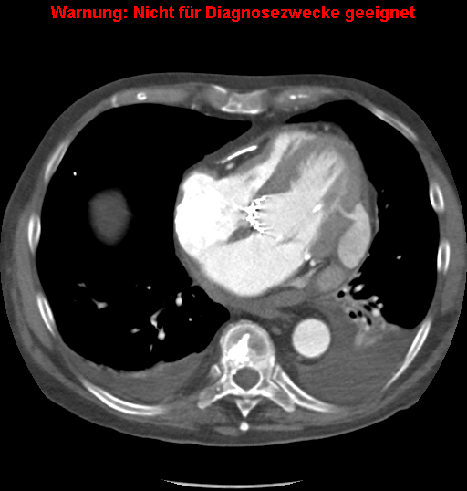 File:Cardiac perforation following transcatheter aortic valve implantation (Radiopaedia 23714-23863 A 8).png