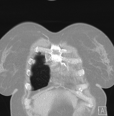 Cardiac sarcoidosis (Radiopaedia 74548-85534 Coronal lung window 4).jpg