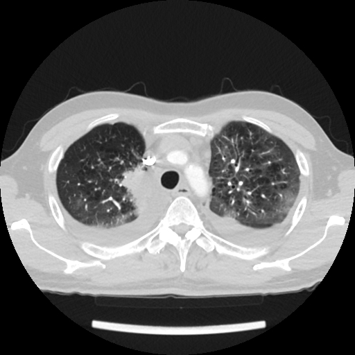 File:Cardiac tamponade (Radiopaedia 78607-91368 Axial lung window 16).jpg