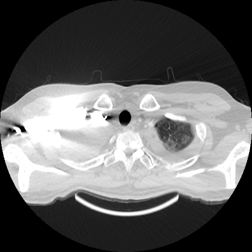 Cardiac tamponade (Radiopaedia 78607-91368 Axial lung window 2).jpg