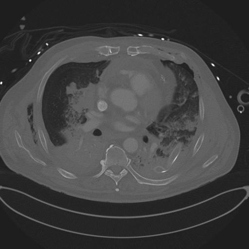 Cardiac trauma (Radiopaedia 32874-33858 Axial bone window 47).jpg