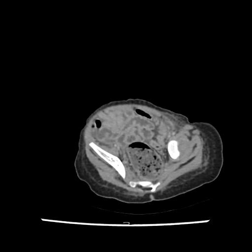 Caroli disease with autosomal recessive polycystic kidney disease (ARPKD) (Radiopaedia 89651-106703 B 198).jpg