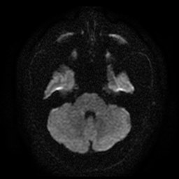 File:Carotid arterial dissection with acute cerebral infarction (Radiopaedia 26636-26784 Axial DWI 6).jpg
