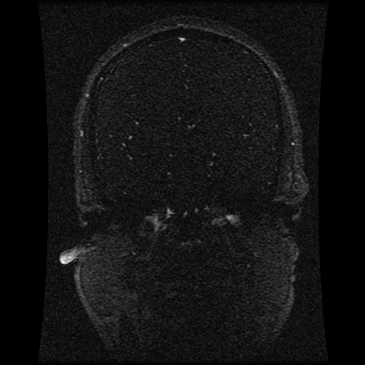 Carotid arterial dissection with acute cerebral infarction (Radiopaedia 26636-26784 MRV 96).jpg