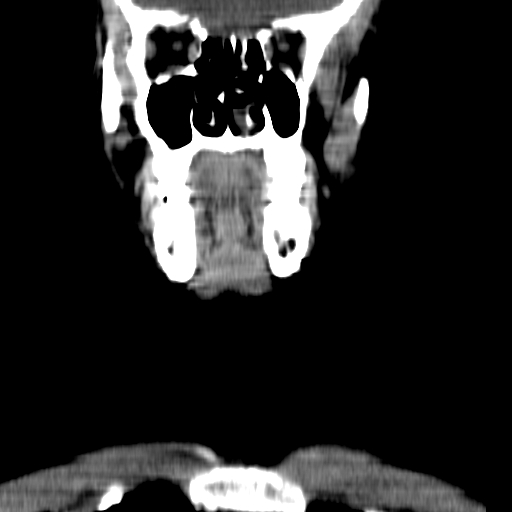 File:Carotid body tumor (Radiopaedia 27890-28124 B 20).jpg