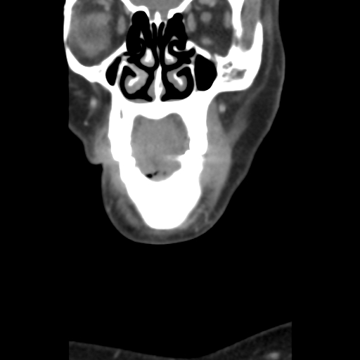 File:Carotid body tumor (paraganglioma) (Radiopaedia 38586-40729 B 7).jpg