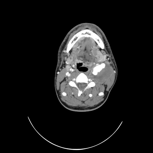 File:Carotid bulb pseudoaneurysm (Radiopaedia 57670-64616 A 31).jpg