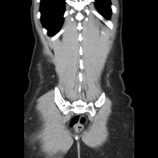 Castleman disease with fibrous pseudotumor in the abdomen (Radiopaedia 77296-89373 B 81).jpg