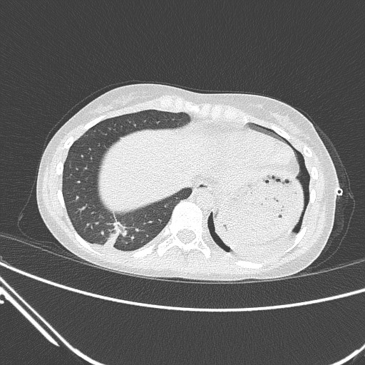 Catamenial pneumothorax (Radiopaedia 27946-28197 lung window 129).jpg