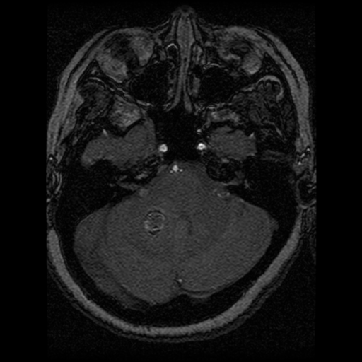 Cavernoma, DVA and right ICA aneurysm (Radiopaedia 33890-35072 E 79).png