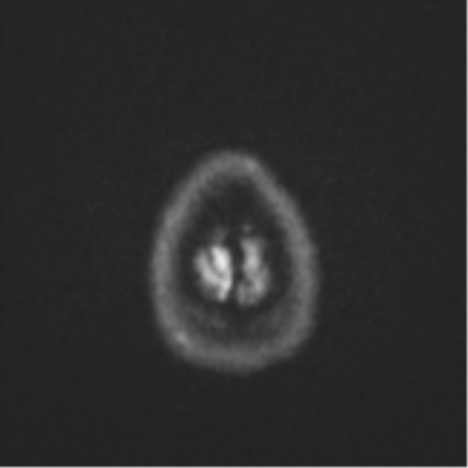 File:Cavernoma with bleed - midbrain (Radiopaedia 54546-60774 Axial DWI 55).png