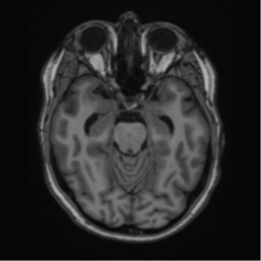 Cavernoma with bleed - midbrain (Radiopaedia 54546-60774 Axial T1 11).png