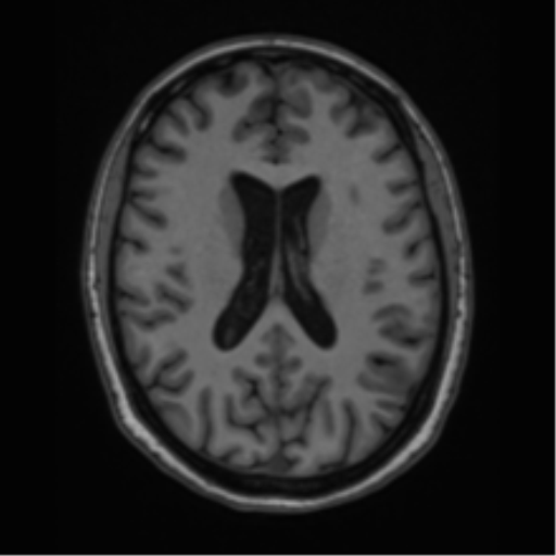 Cavernoma with bleed - midbrain (Radiopaedia 54546-60774 Axial T1 29).png