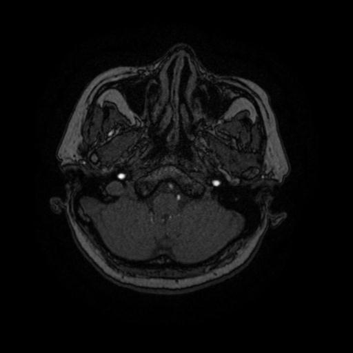 Cavernoma with developmental venous anomaly (Radiopaedia 22470-22507 MRA 85).jpg