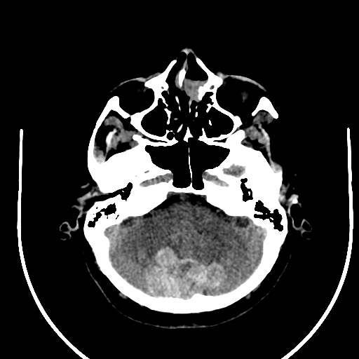 Cavernous hemangioma of the cerebellar falx (Radiopaedia 73025-83723 Axial non-contrast 30).jpg