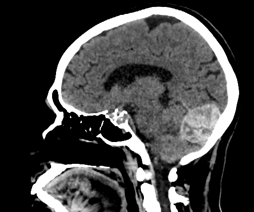 Cavernous hemangioma of the cerebellar falx (Radiopaedia 73025-83723 B 146).jpg