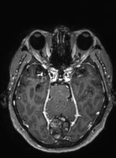 Cavernous hemangioma of the cerebellar falx (Radiopaedia 73025-83724 Axial T1 C+ 219).jpg