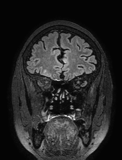 Cavernous hemangioma of the cerebellar falx (Radiopaedia 73025-83724 Coronal FLAIR 77).jpg