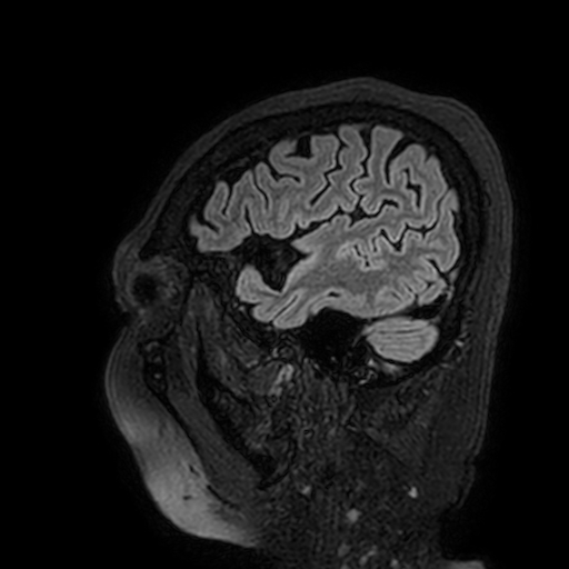 File:Cavernous hemangioma of the cerebellar falx (Radiopaedia 73025-83724 Sagittal FLAIR 27).jpg