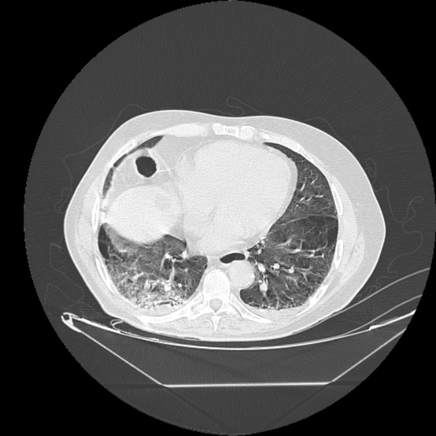 Cavitating bronchogenic carcinoma (Radiopaedia 44489-48162 Axial lung window 58).jpg