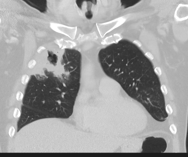 File:Cavitating pneumonia (Radiopaedia 45998-50329 Coronal lung window 16).png