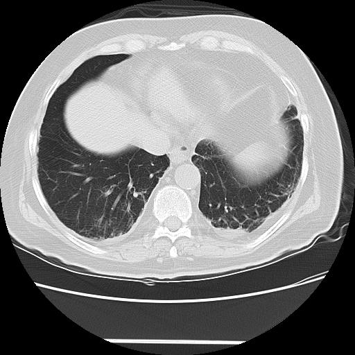 Cavitating pulmonary metastases (Radiopaedia 89545-106544 Axial lung window 43).jpg