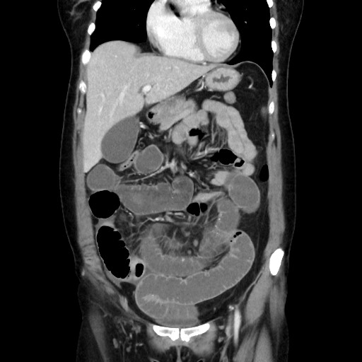 Cecal adenocarcinoma (Radiopaedia 75909-87331 B 19).jpg