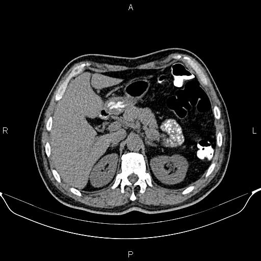 Cecal adenocarcinoma (Radiopaedia 85324-100916 Axial non-contrast 25).jpg