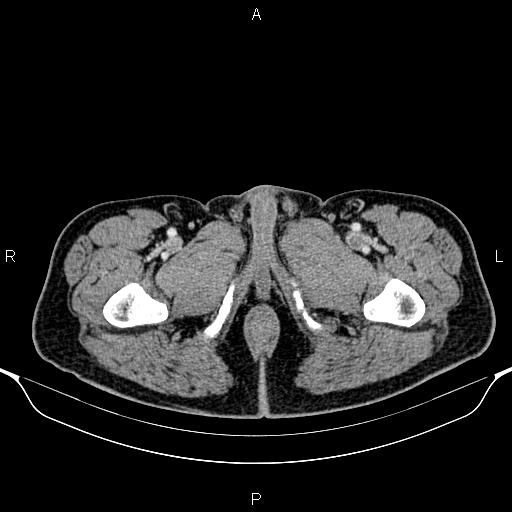Cecal adenocarcinoma (Radiopaedia 85324-100916 B 111).jpg