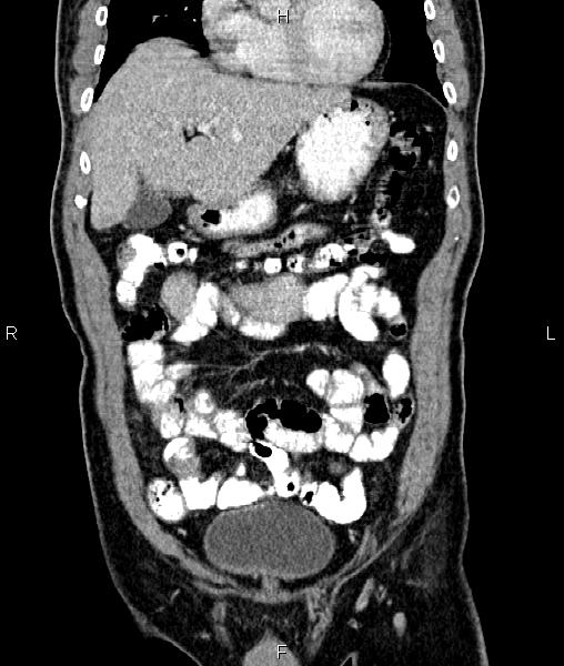 Cecal cancer with appendiceal mucocele (Radiopaedia 91080-108651 D 20).jpg