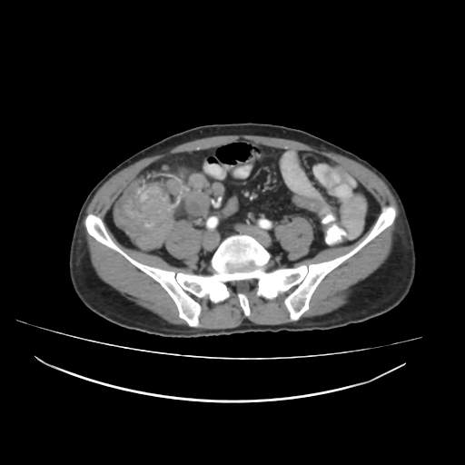 Cecal carcinoma with local lymphadenopathy (Radiopaedia 31428-32240 A 35).jpg