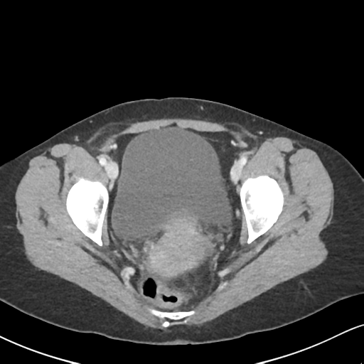 Cecal internal hernia through the foramen of Winslow (Radiopaedia 44820-48651 B 69).png