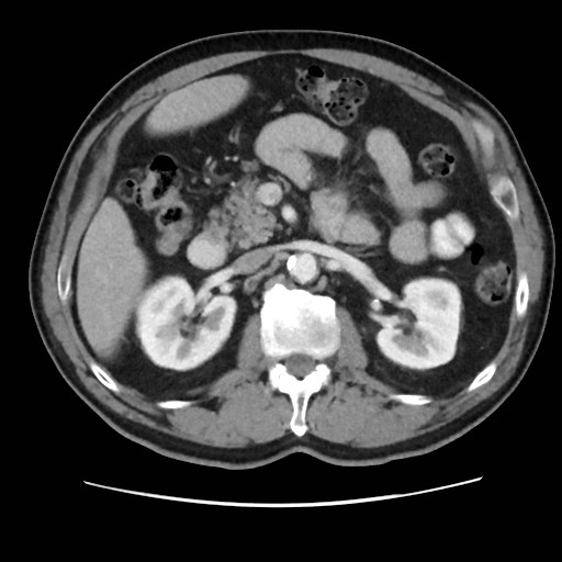Cecal mass causing appendicitis (Radiopaedia 59207-66531 A 33).jpg