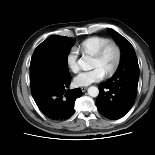 Cecal mass causing appendicitis (Radiopaedia 59207-66531 A 4).jpg