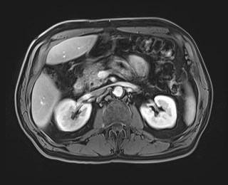 Cecal mass causing appendicitis (Radiopaedia 59207-66532 T1 C+ PV phase 54).jpg
