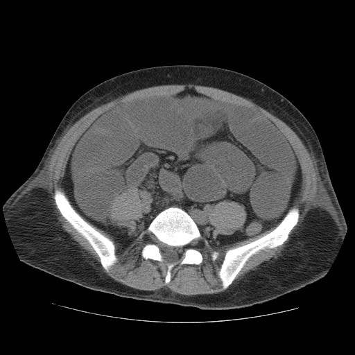 Cecal volvulus (Radiopaedia 28294-28534 Axial non-contrast 69).jpg