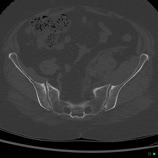 Central fracture-dislocation of the acetabulum (Radiopaedia 36578-38150 Axial bone window 19).jpg