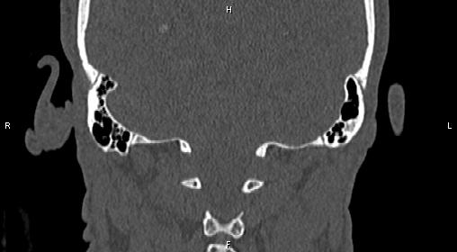 File:Central giant cell granuloma (Radiopaedia 83346-97761 Coronal bone window 41).jpg