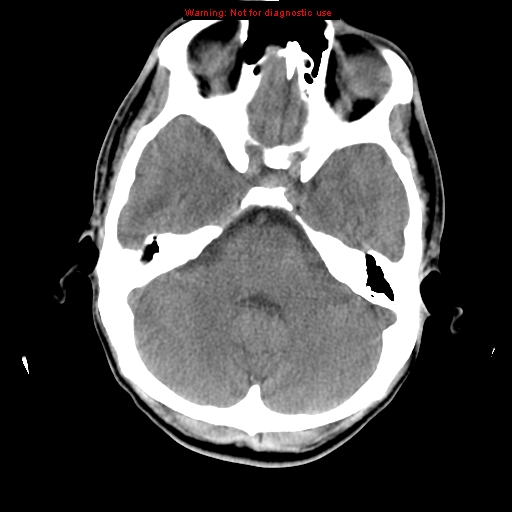File:Central nervous system vasculitis (Radiopaedia 8410-9234 Axial non-contrast 31).jpg