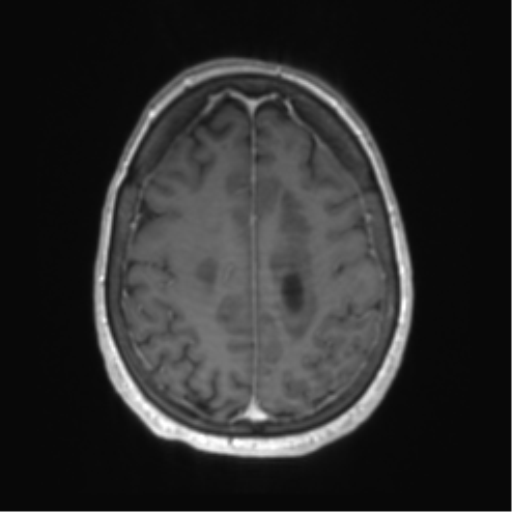 Central neurocytoma (Radiopaedia 65317-74345 Axial T1 C+ 45).png