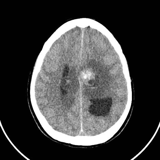 Central neurocytoma (Radiopaedia 84497-99871 Axial non-contrast 36).jpg