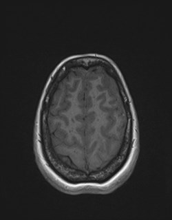 Central neurocytoma (Radiopaedia 84497-99872 Axial T1 161).jpg