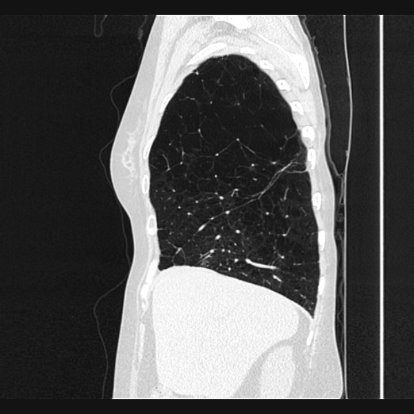 Centrilobular pulmonary emphysema (Radiopaedia 24495-24789 Sagittal lung window 17).jpg