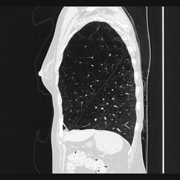 Centrilobular pulmonary emphysema (Radiopaedia 24495-24789 Sagittal lung window 69).jpg