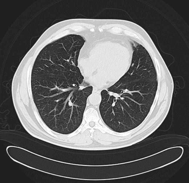 Centrilobular pulmonary emphysema (Radiopaedia 26808-26971 C 29).jpg