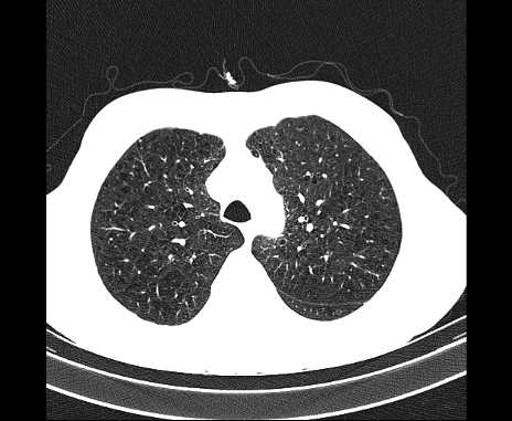 Centrilobular pulmonary emphysema (Radiopaedia 62468-70718 Axial lung window 19).jpg