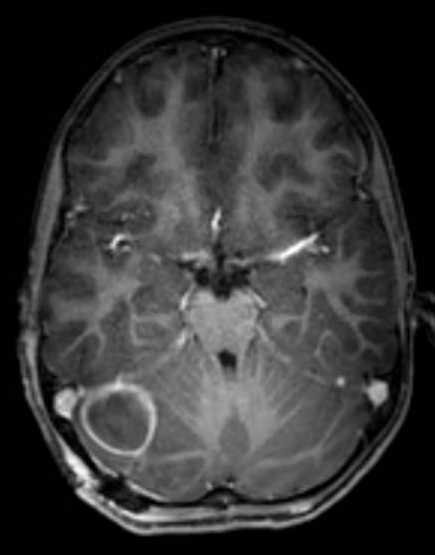 Cerebellar abscess (Radiopaedia 73727-84563 Axial T1 C+ fat sat 53).jpg
