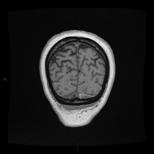 Cerebellar abscess (Radiopaedia 78135-90678 Coronal T1 C+ 152).jpg